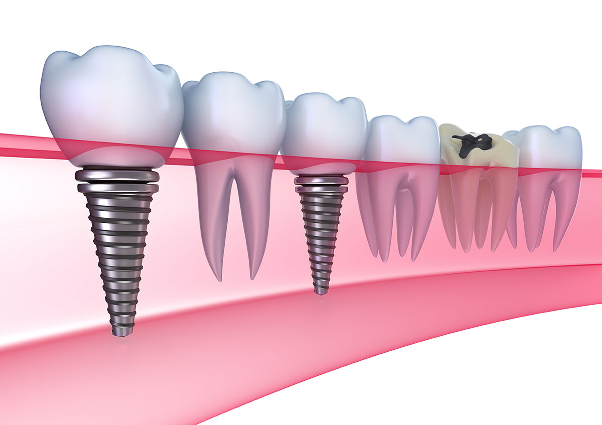 dental implants