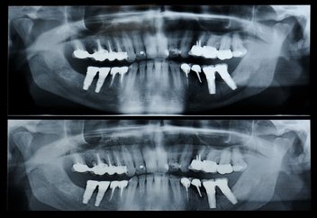 Dental x-ray images