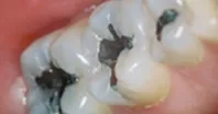 metal dental fillings