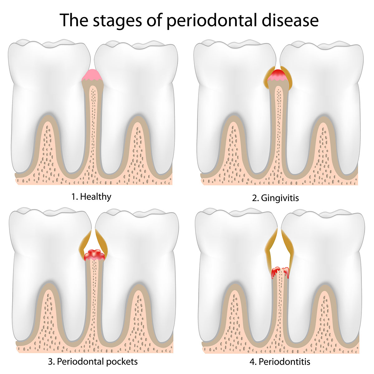 Stages of periodontal disease