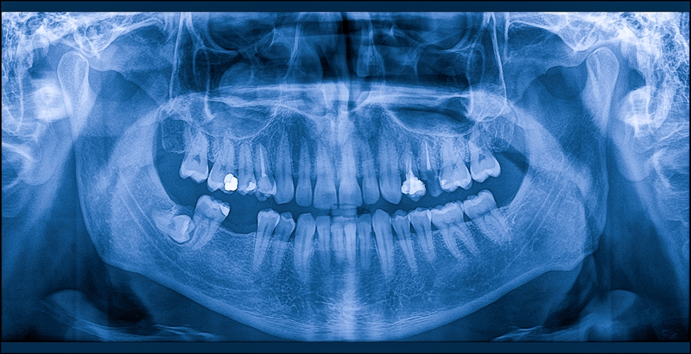 dental x-rays